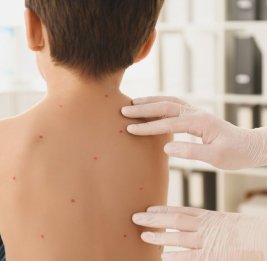 Ветрянка активизировалась 