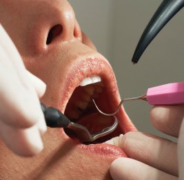 Врач назвала опасные последствия кариеса для всего организма