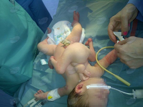 Азербайджанские врачи провели операцию ребенку, родившемуся с четырьмя руками и ногами