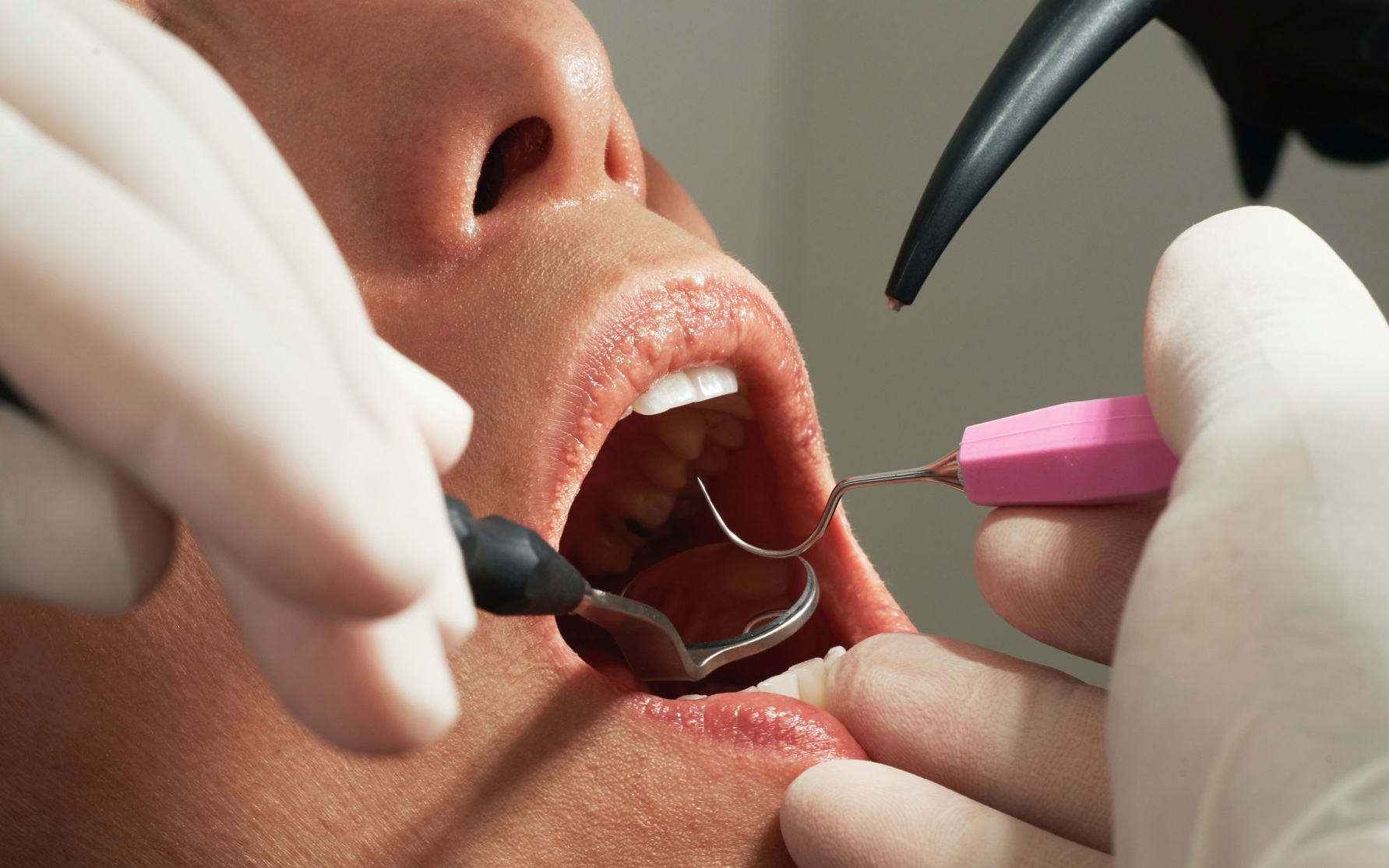 Врач назвала опасные последствия кариеса для всего организма